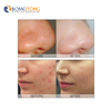 Oxygen jet dermabrasion skin peel facial machine Anti -Aging Skin rejuvenatio deep cleaning Aqua Korea Skin Care