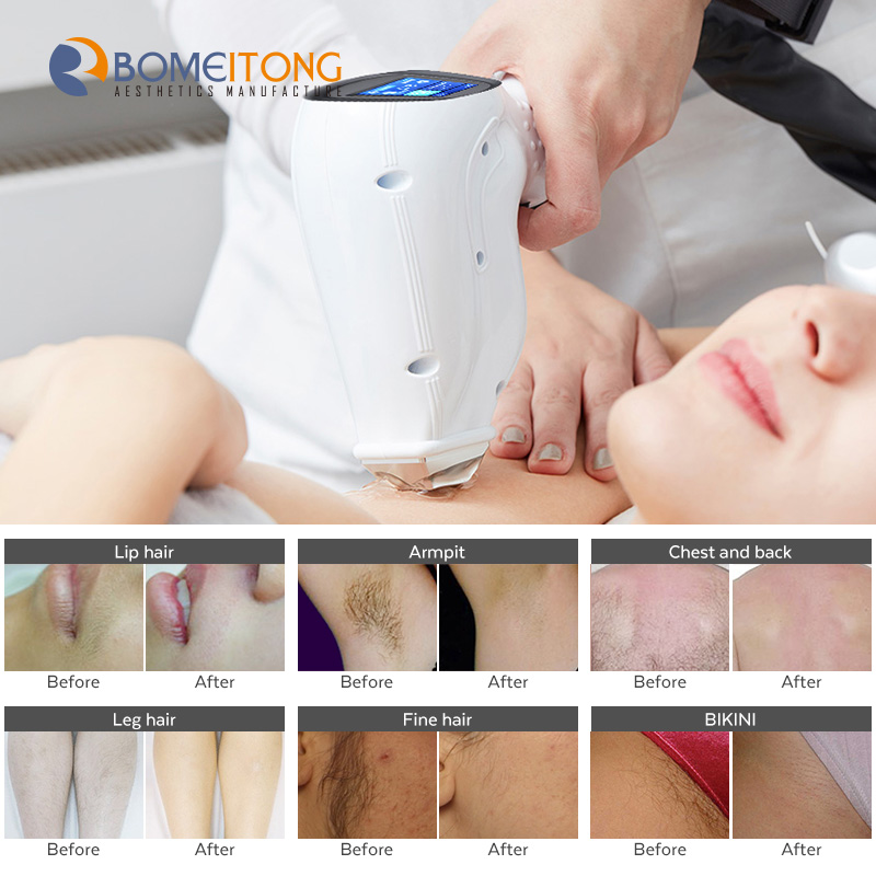 755 808 1064nm Diode Laser Hair Removal with Powerful Double Cooling System
